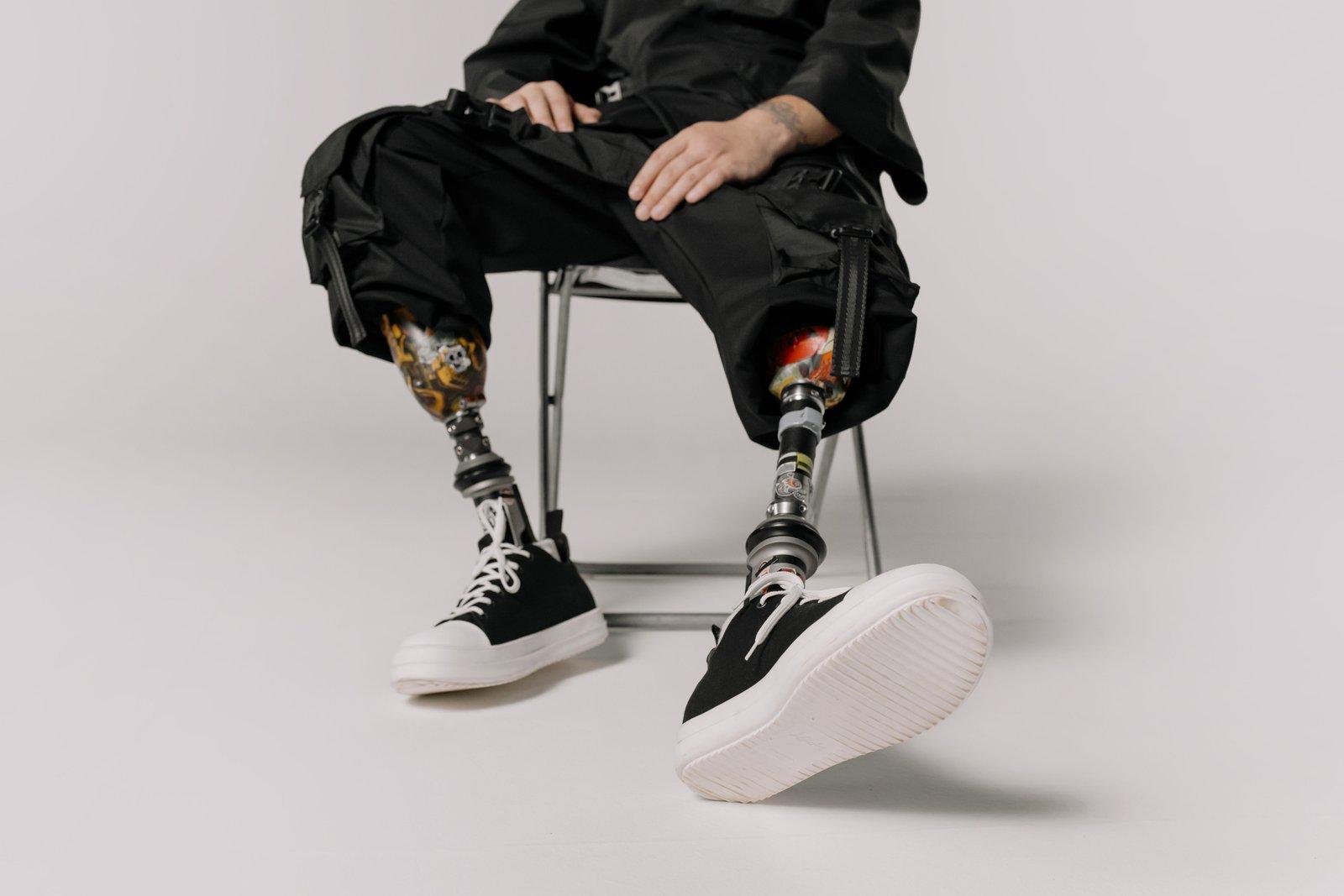 Patient seated, wearing two custom below-knee prostheses